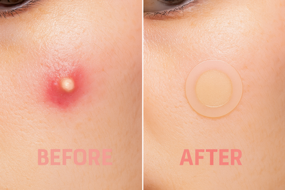 Vegan Pimple Patch